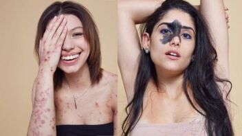 Девушки с витилиго, стомой, шрамами для социального проекта на YouTube